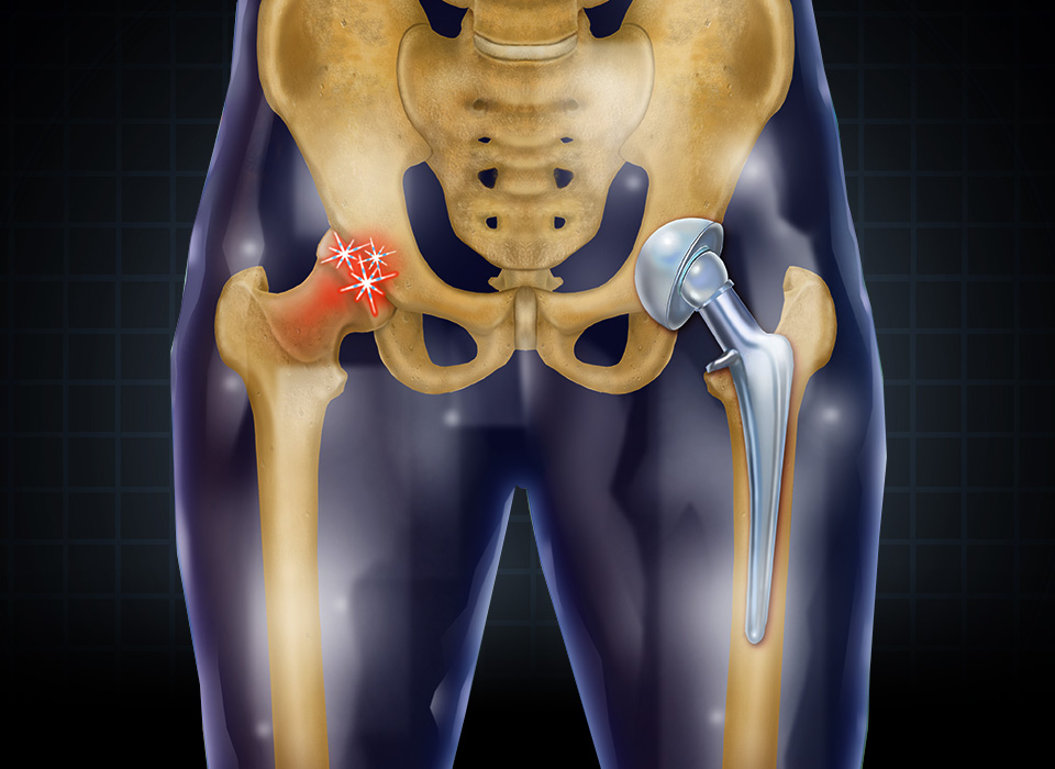 Hip - Replacement Hip Replacement