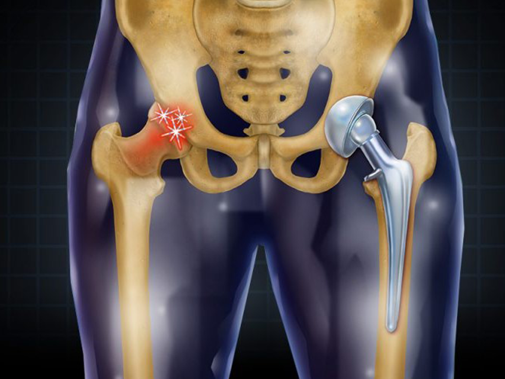 Sancheti Hospital Total Hip Replacement.