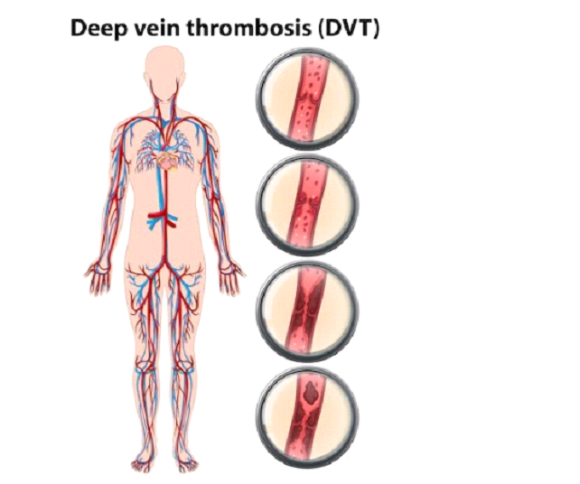 Deep Vein Thrombosis