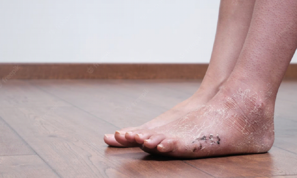 Post-operative Immbolization