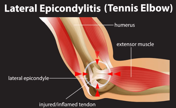 Tennis elbow